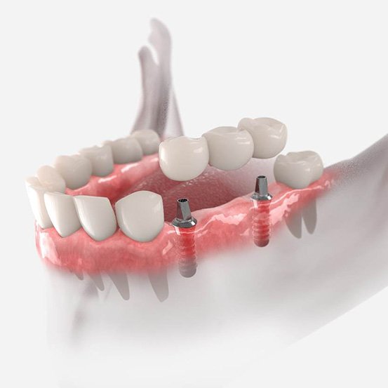dental implant bridge on lower jaw
